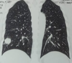 Aasra- Lung cancer
